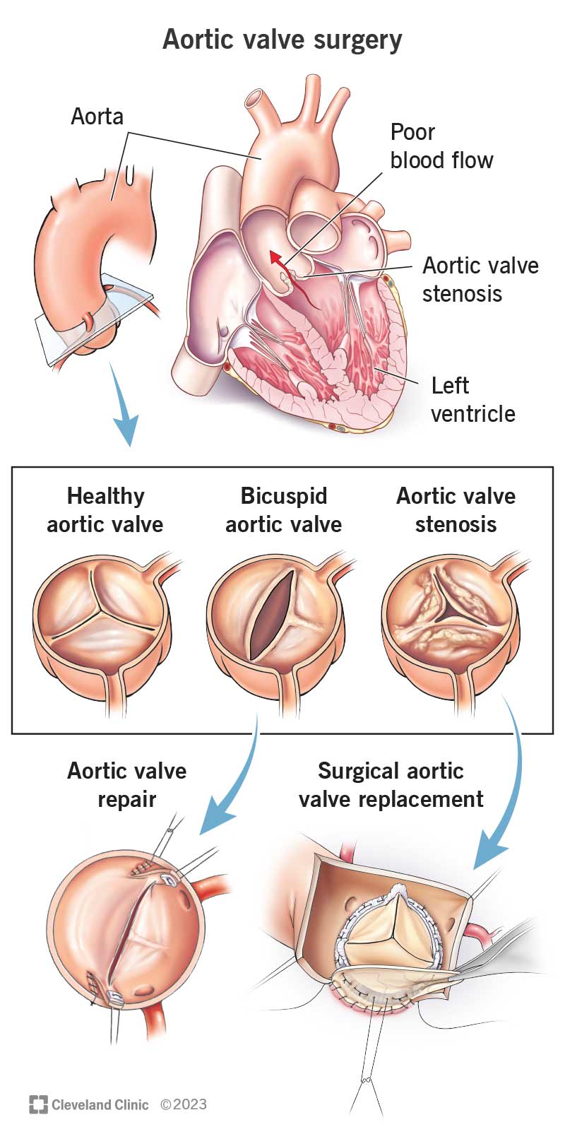 Bypass and Valve Replacement Surgery Recovery Guide