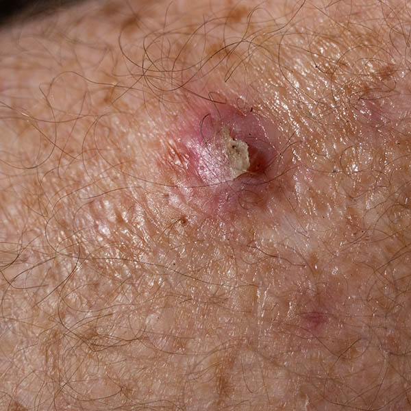 Early Stage Squamous Cell Skin Cancer Pictures Guide
