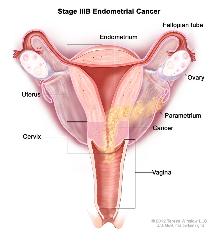 FIGO Grade 2 Endometrial Cancer Treatment Guide