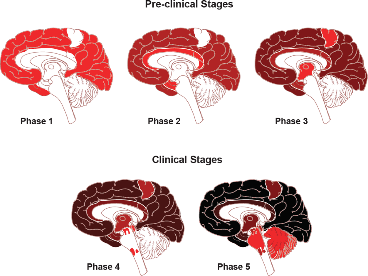 How Is Alzheimer’s Transmitted? Myths & Facts Explained