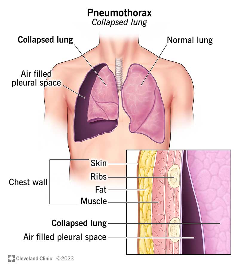 How Long After a Lung Biopsy Can Your Lung Collapse?