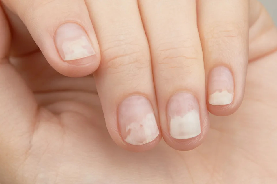 Hypothyroidism Nails Pictures: Spot Signs & Fix Fast
