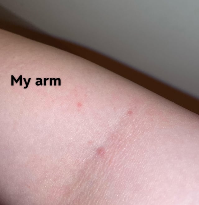 Is Dove Soap Good for Hives? Find Out If It Helps