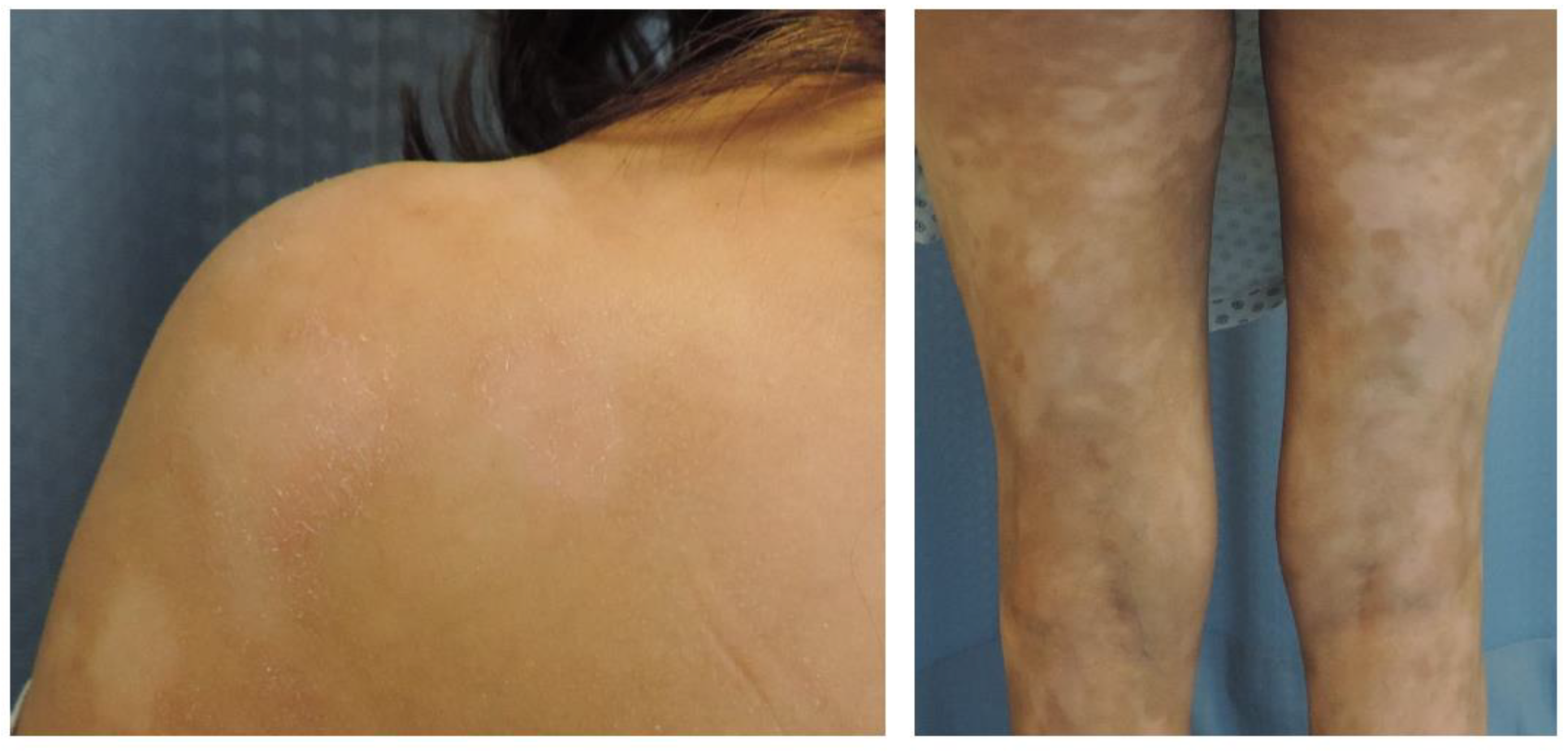 Is hypopigmented mycosis fungoides cancer? Quick facts