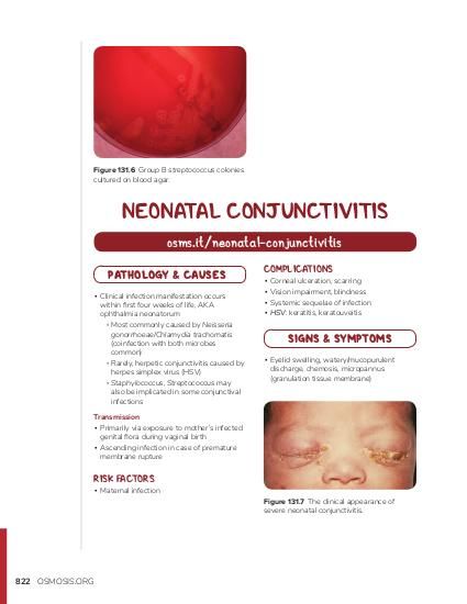 Neonatal Conjunctivitis Treatment: A Parent’s Guide