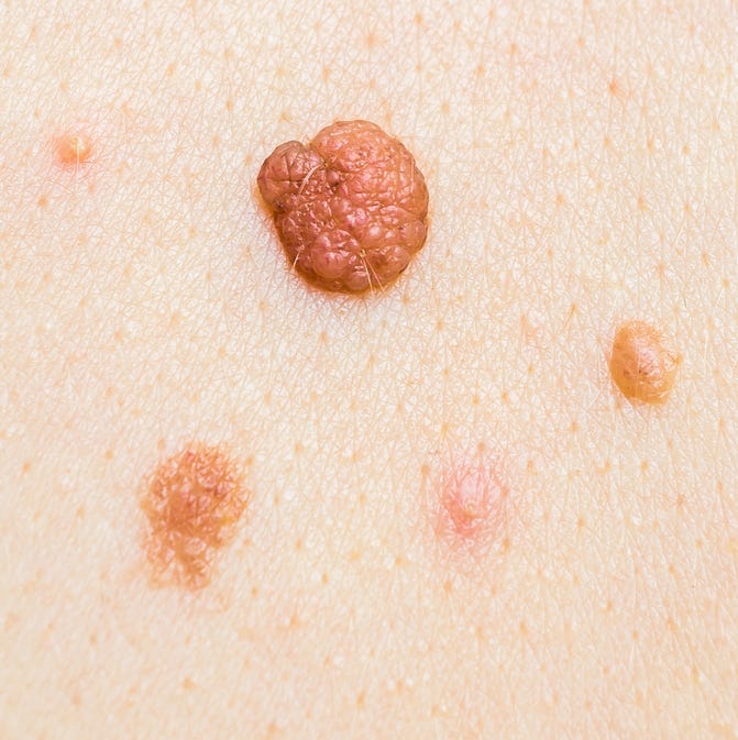 Pictures of Cancerous Moles: Spot the Signs Early