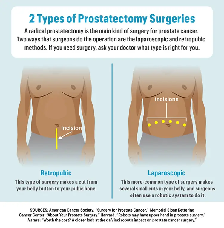 Retropubic Prostatectomy: What It Is and What to Expect