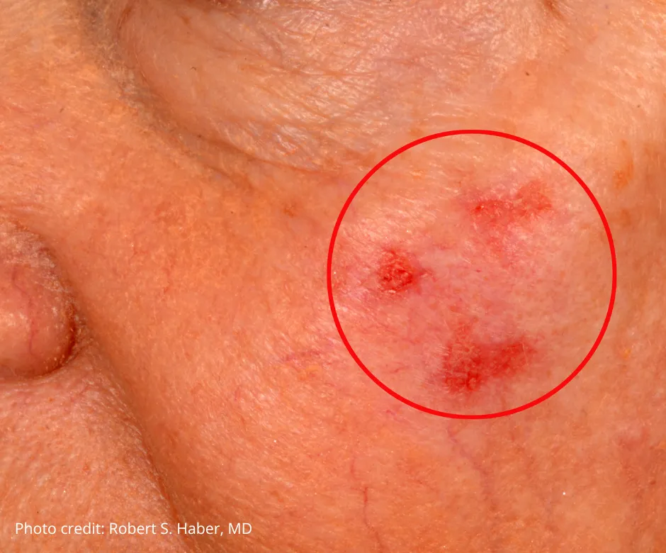 Skin Cancer Spots on Face: Identify, Understand, Act