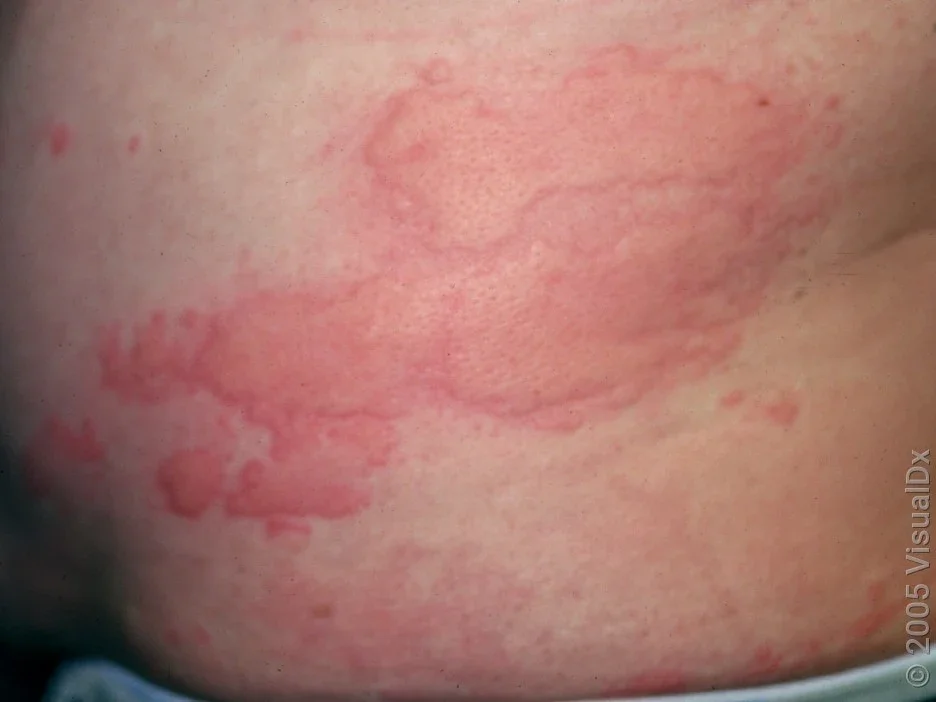 Stress Hives Pictures: Identify & Understand Guide