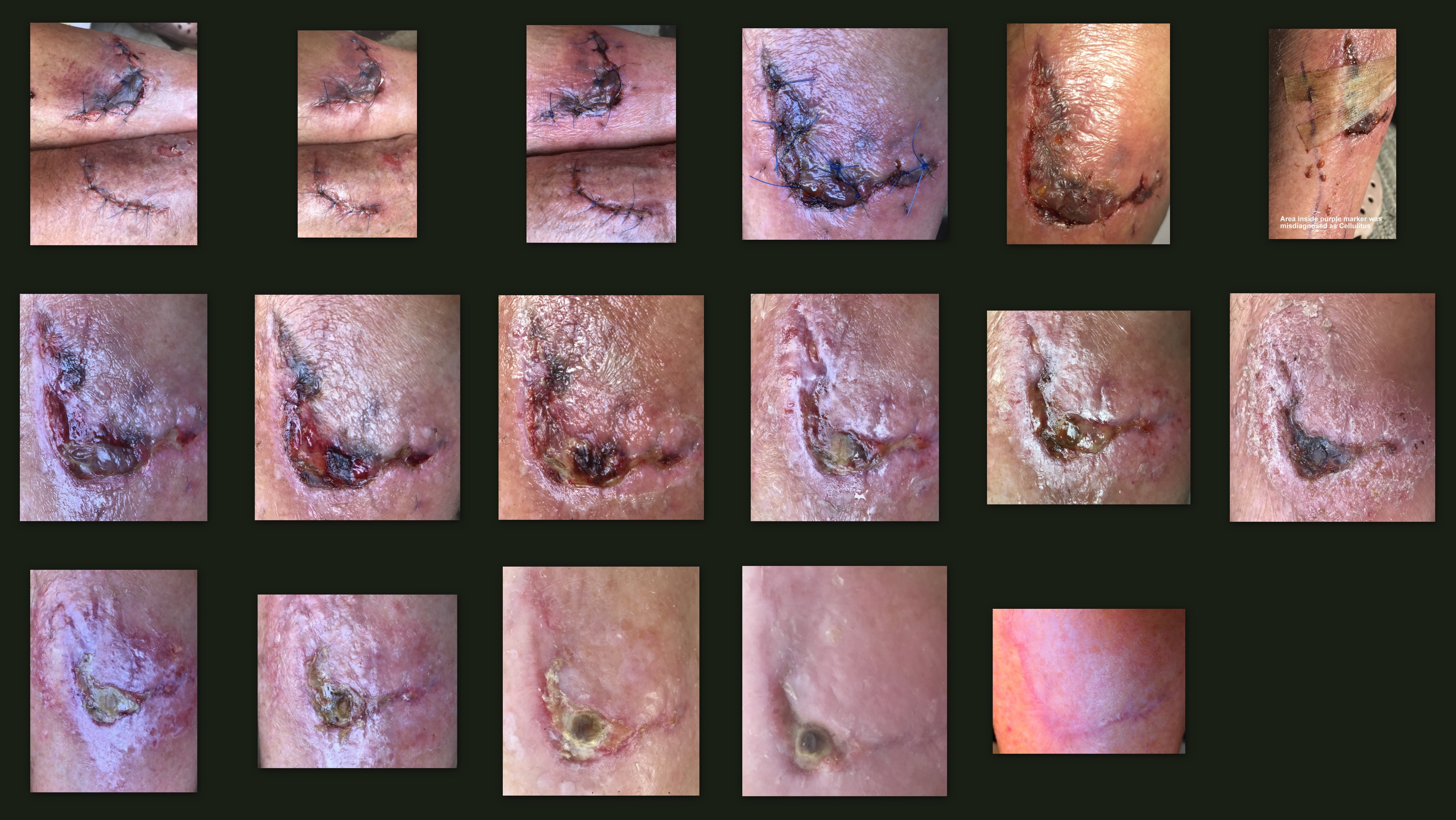 Surgical Wound Healing Stages Timeline – What to Expect