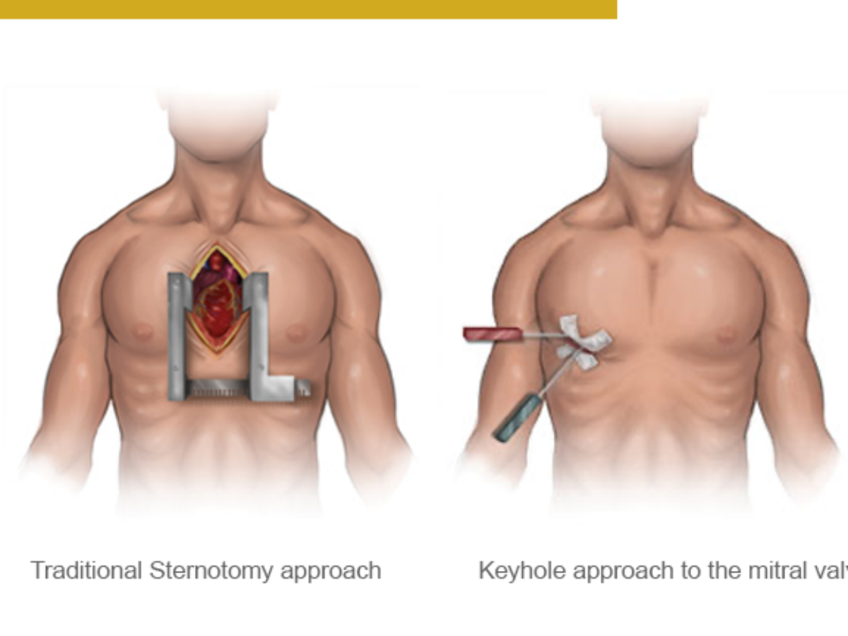 Transcatheter Mitral Valve Replacement Recovery Time