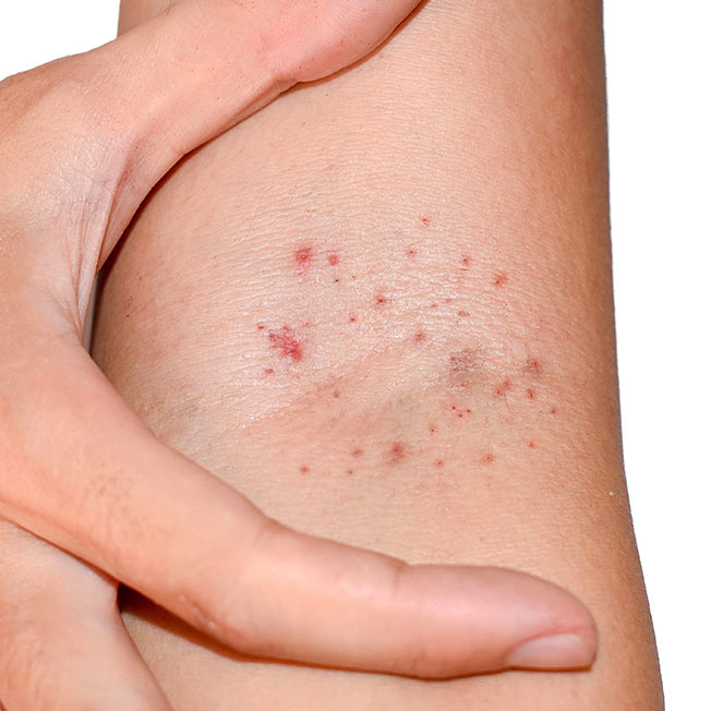 What Cancer Can Cause Itchy Skin? Quick Answers