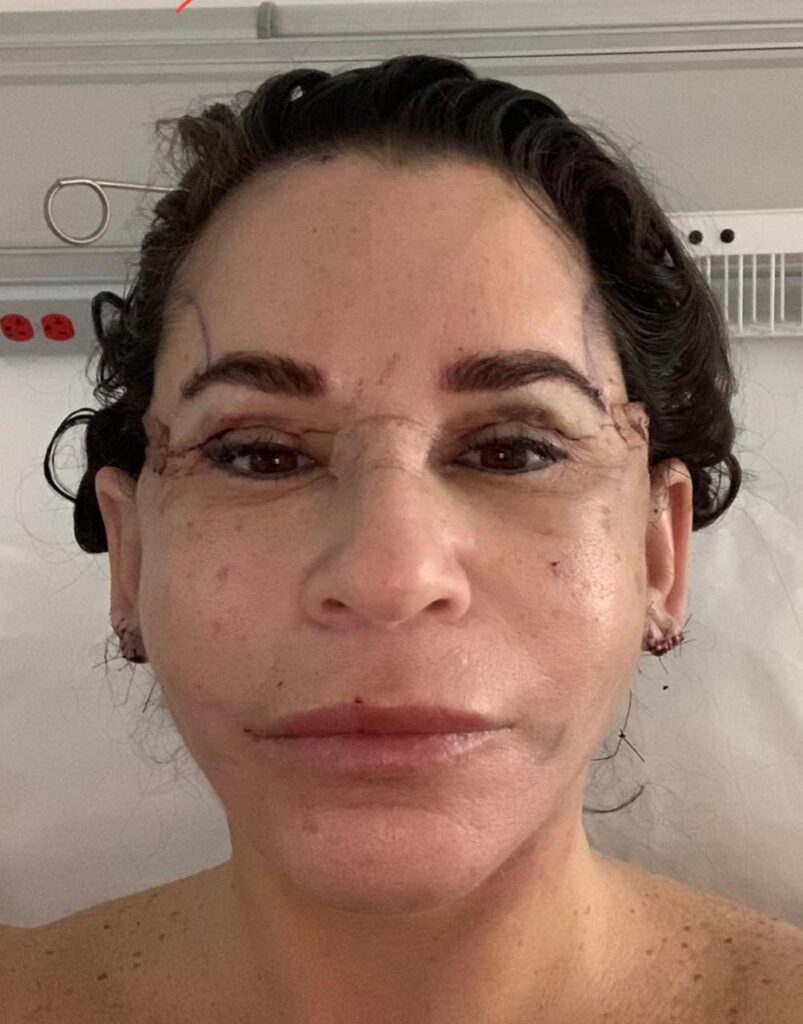 What Is Considered Day 3 After Surgery? Quick Guide