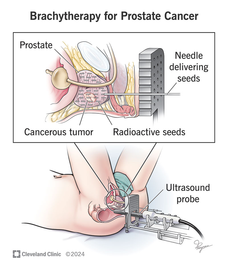 What Is the Most Effective Prostate Cancer Treatment?