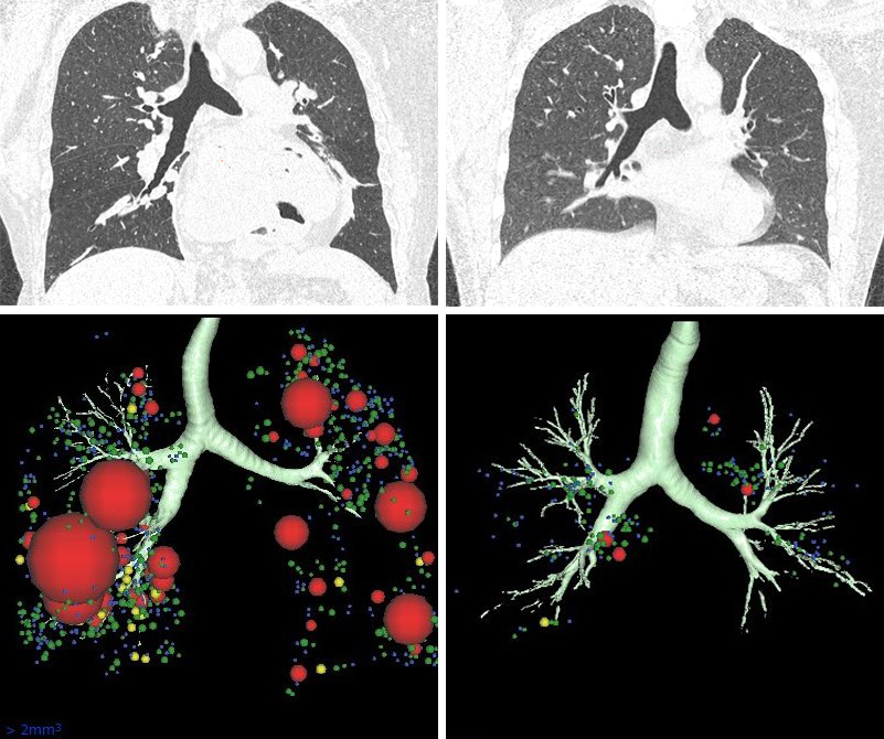 CT Scan for Asthma Patients: What You Need to Know