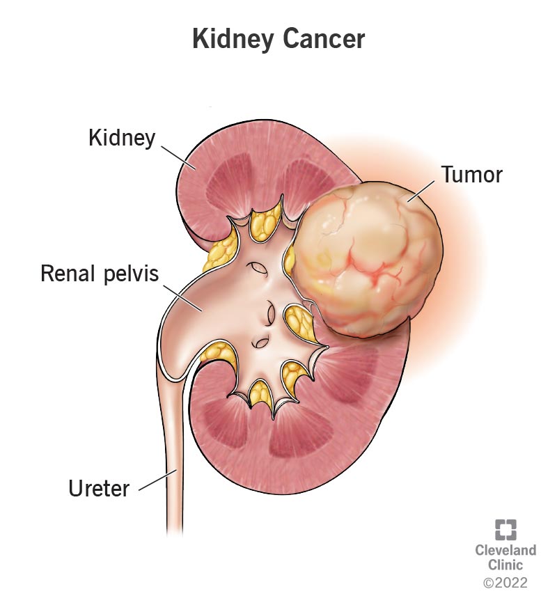 How I Found Out I Had Kidney Cancer – My Story & Tips