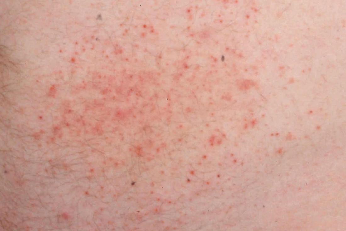 Mild Gluten Rash Pictures: Spot, Understand & Act