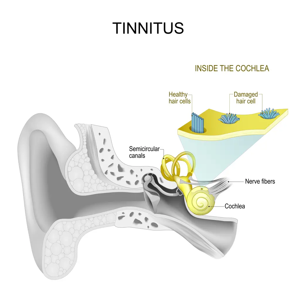 My Tinnitus Went Away After 3 Months – Real Story