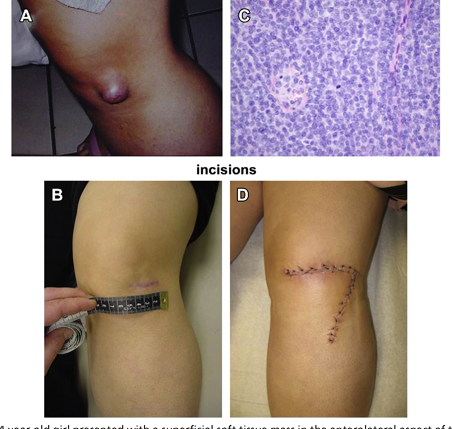 Soft Tissue Sarcoma in Children: Key Facts for Parents