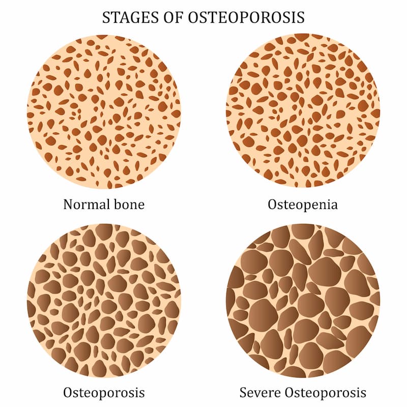 Stages of Osteoporosis Pictures: Visual Guide for You