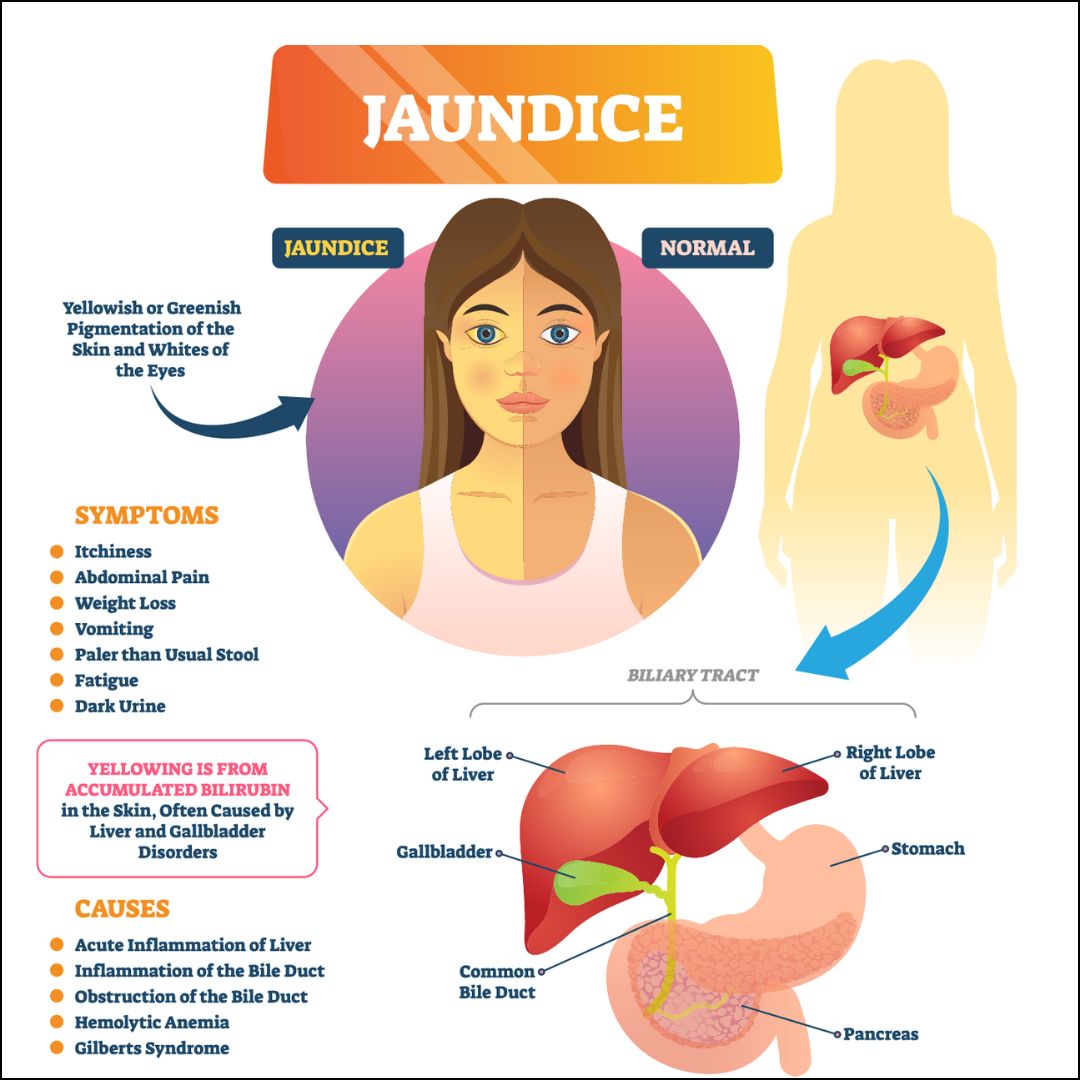Symptoms of Jaundice From Gallstones: What to Watch