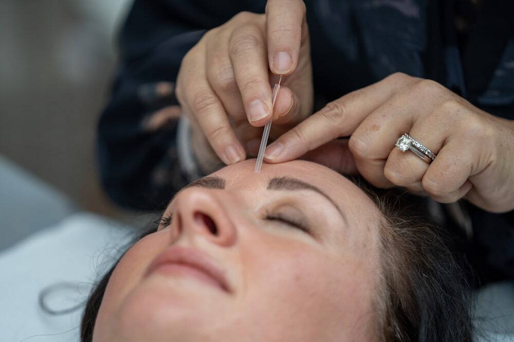 Acupuncture for Hayfever: Fast Relief & What to Expect