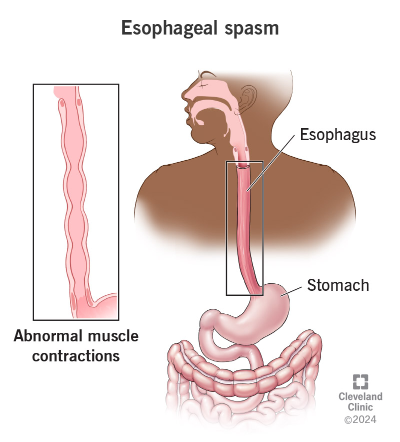 Can You Die From Esophageal Spasms? Facts, Risks & Relief