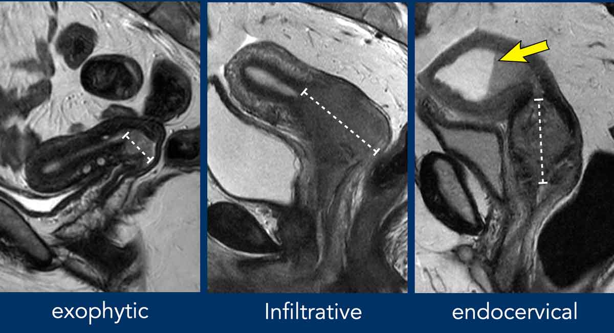 Cervical Stroma MRI: Guide to Accurate Staging
