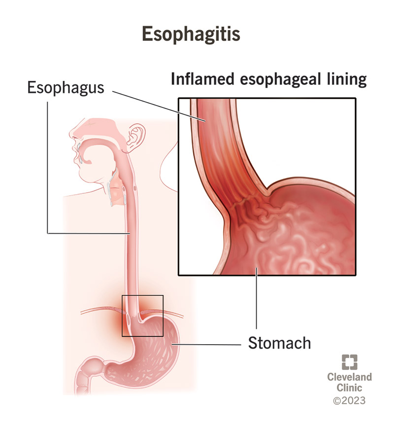 Esophagus Pain When Swallowing: Causes & Relief