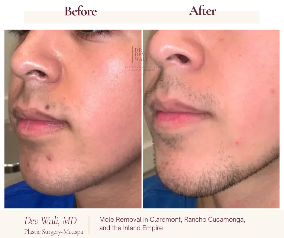 How to Remove Flat Moles from Face Permanently