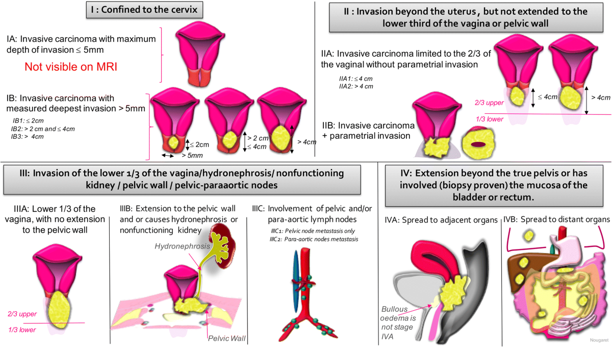 Latest FIGO Staging of Cervical Cancer: Key Takeaways