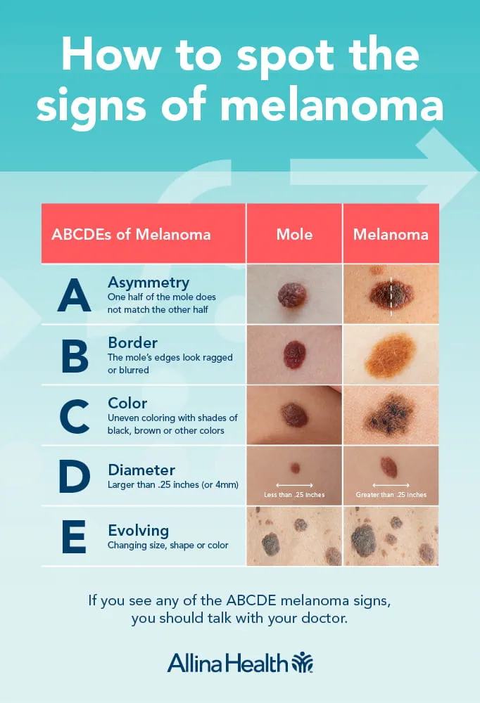 Melanoma Mole: Signs, Stages & Treatment Guide