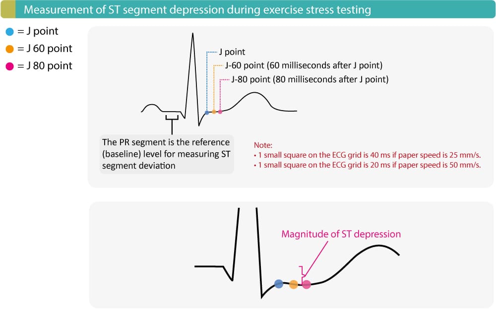 Positive ECG Stress Test Criteria: What Really Counts
