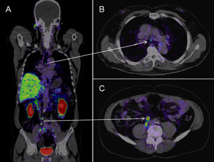 PSMA PET/CT Scan: What You Need to Know Today