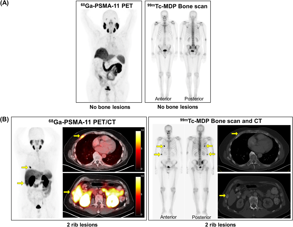 PSMA PET Scan vs PET Scan: What You Need to Know