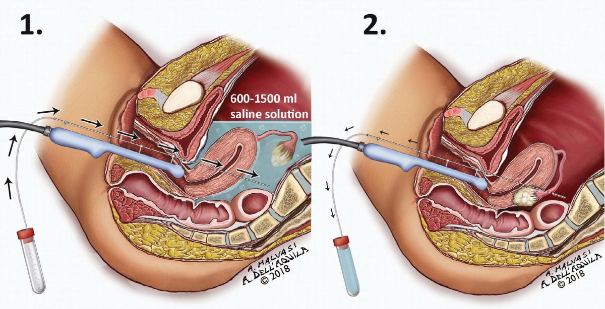 Signs of Infection After Egg Retrieval – What to Know