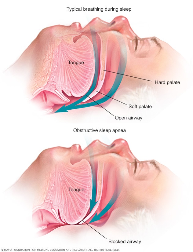 Key Signs You Stop Breathing While Sleeping At Night