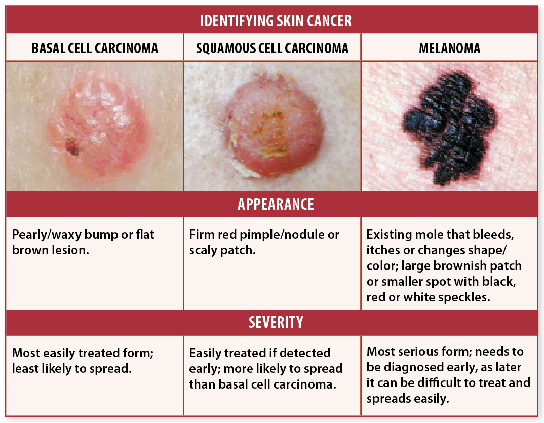 Skin Cancer White Mole: Spot It Early, Stay Safe