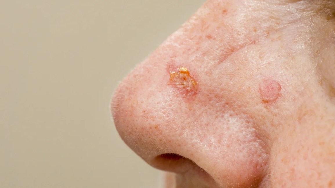 Skin Lesions on Face Images: Types, Risks & How to Spot