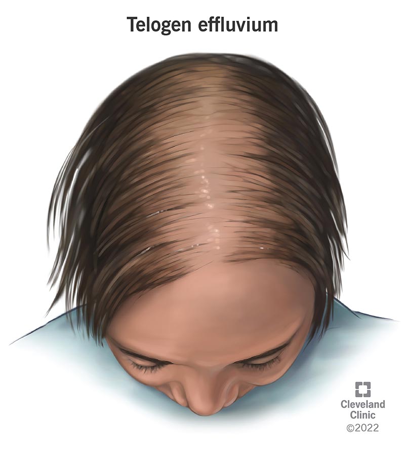 Telogen Effluvium – Why Hair Falls Out & How to Recover
