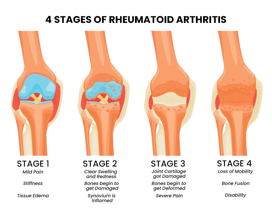 What Are the 4 Stages of Rheumatoid Arthritis? Explained