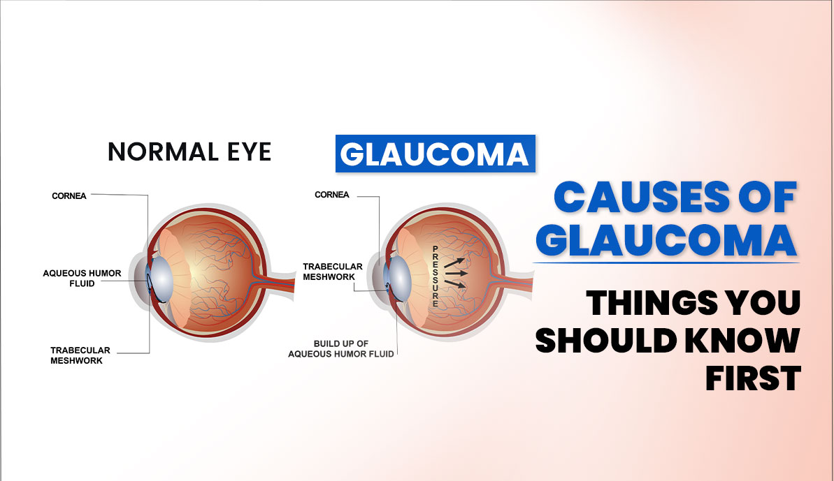 What Causes Glaucoma? Triggers, Risks & Prevention