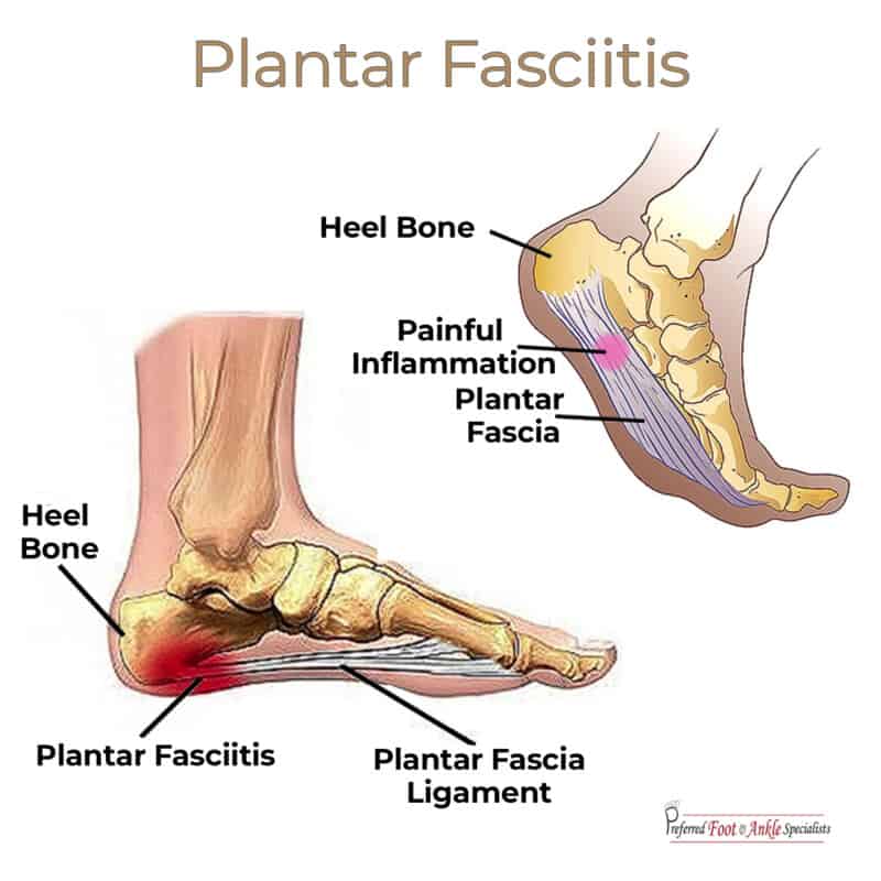 What Causes Gout in the Heel? Find Relief Fast