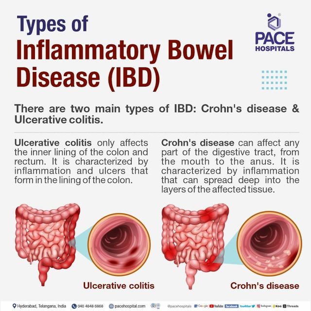 Bowel Infection Names: Symptoms, Causes & Treatment