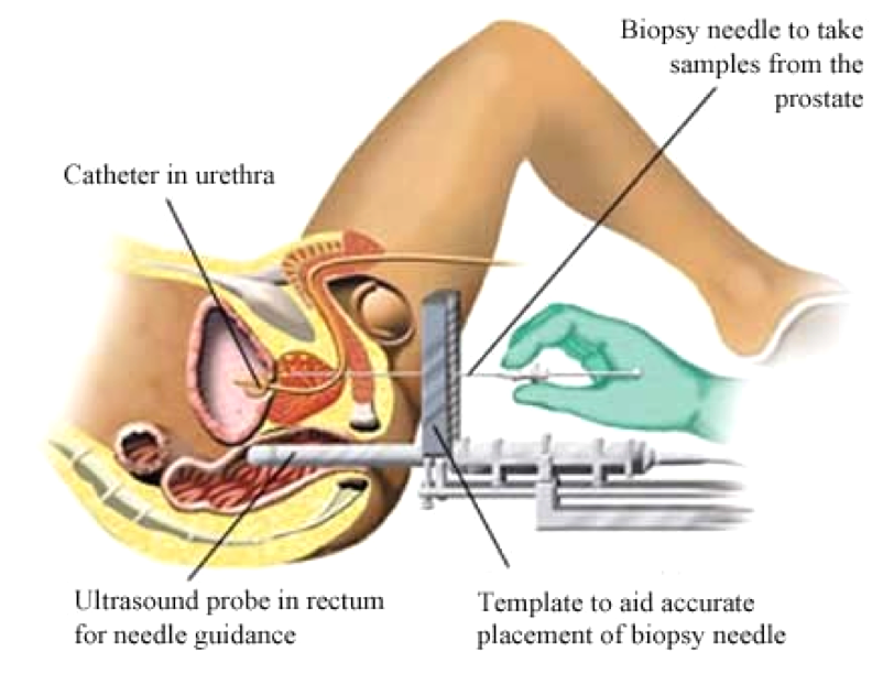 How Accurate Is a Prostate Biopsy? Real Answers
