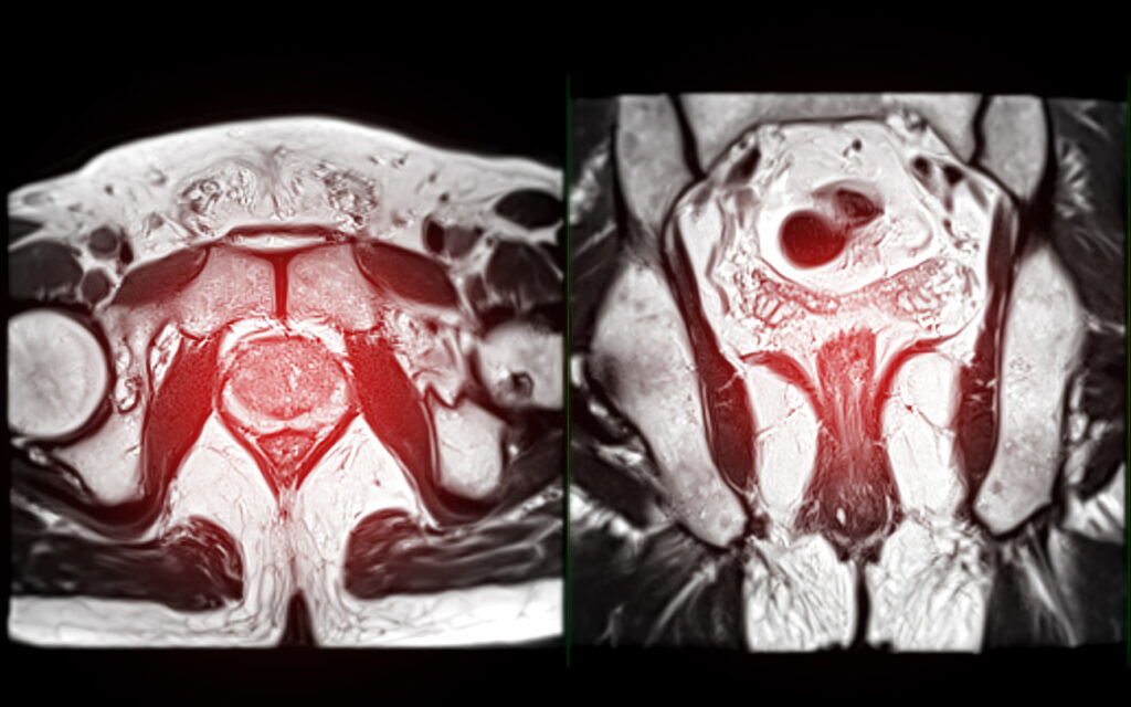 Is prostate biopsy necessary after MRI? Find out the truth