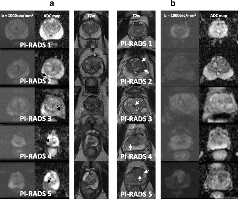 Prostate MRI Results 1-5: What the Scores Mean