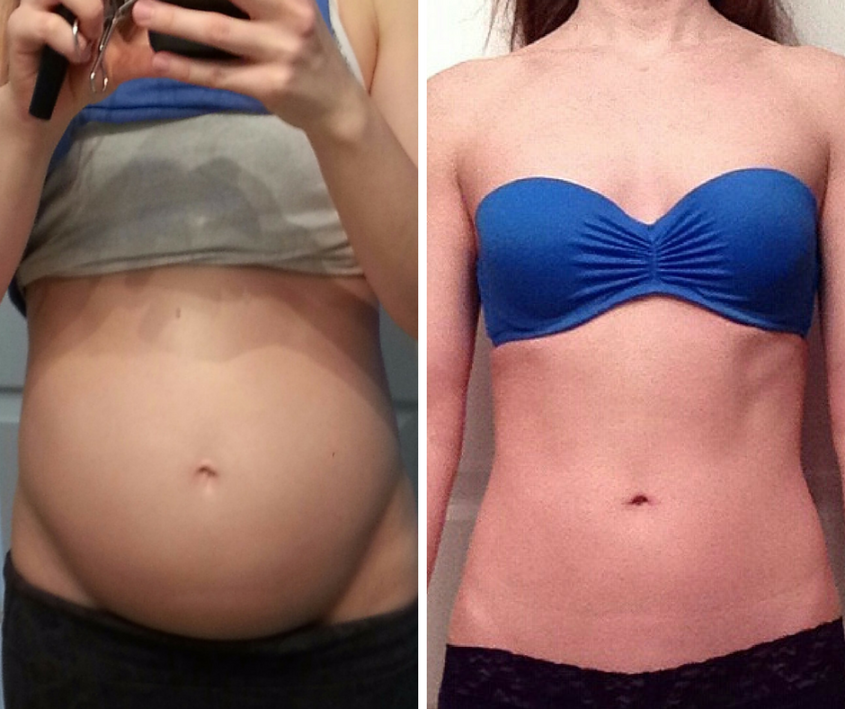 SIBO Belly: Causes, Symptoms, Treatment & Diet Guide