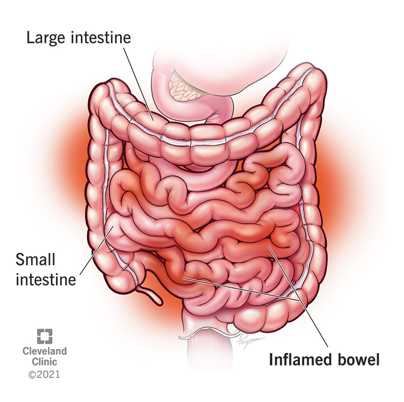 Small Intestine Infection Symptoms – What to Watch For
