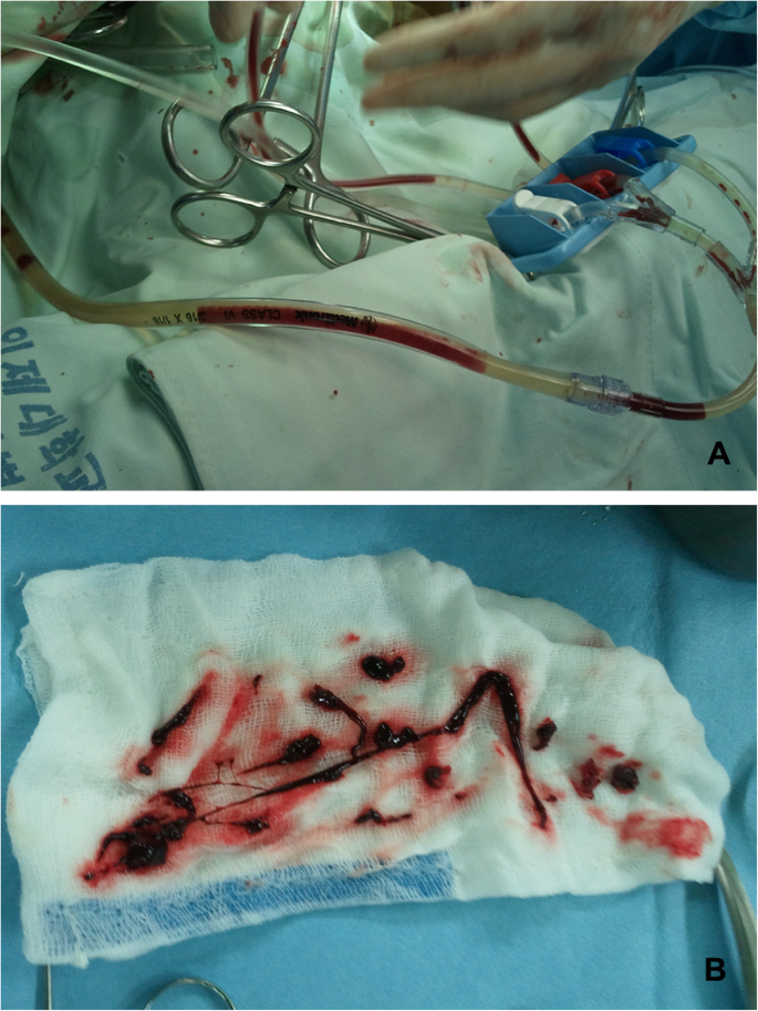 Blood Clot in Heart Surgery – Risks, Signs & Treatment